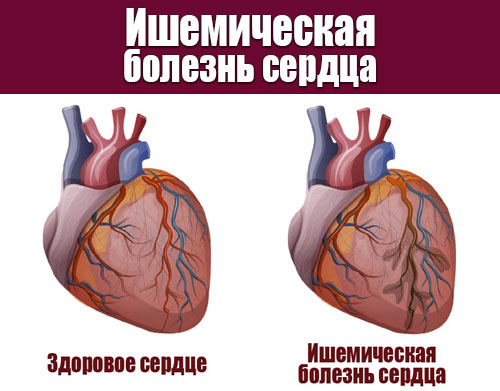 ИБС ишемическая болезнь сердца